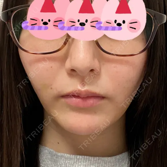 糸リフト / 脂肪吸引（顔） 東京美専クリニック DAY 13 メイン用