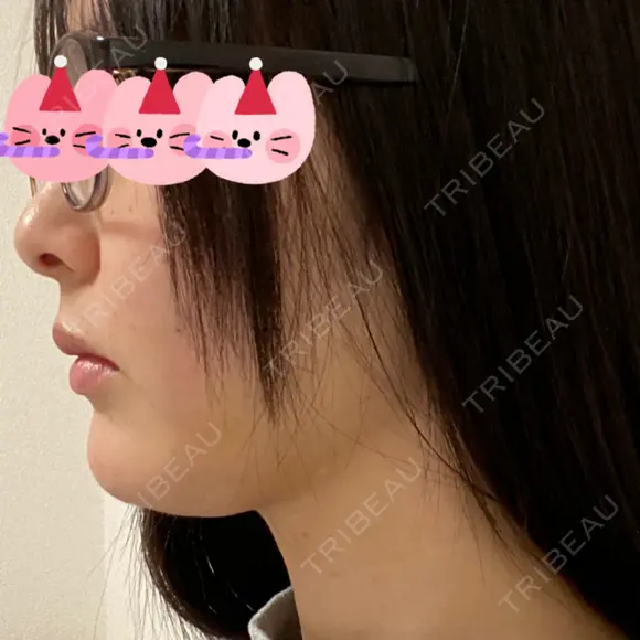 糸リフト / 脂肪吸引（顔） 東京美専クリニック DAY 13 メイン用