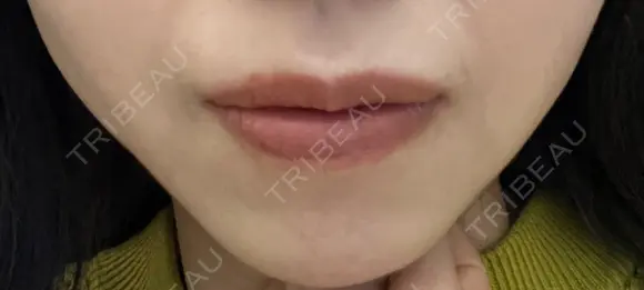 ボトックス（口角） ルラ美容クリニック 名古屋本院 DAY 7 メイン用