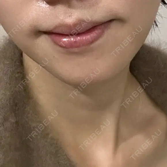 ボトックス（あご） / シワ取りボトックス / マイクロボトックス / ボトックス（眉間） / ボトックス（額） KAGA CLINIC DAY 12 メイン用