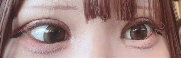 二重切開 / 目頭切開 / 眼瞼下垂（切開） オーキッド美容クリニック東京御徒町 DAY 14 メイン用