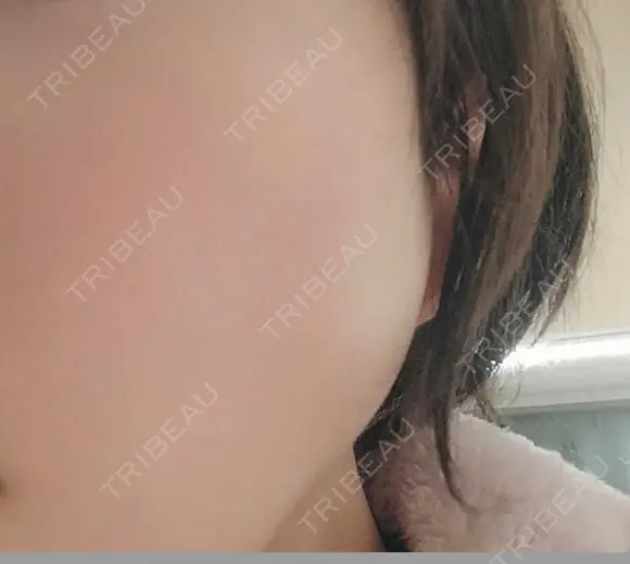 ボトックス（エラ・小顔） 湘南美容クリニック 本厚木院 DAY 27 メイン用