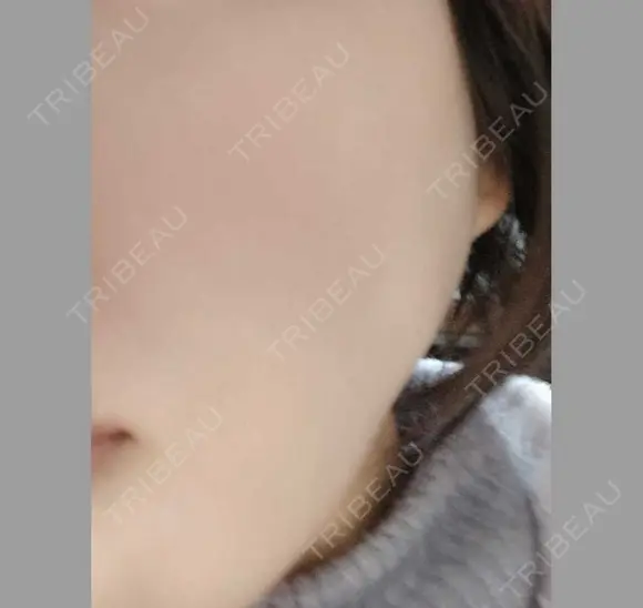 ボトックス（エラ・小顔） 湘南美容クリニック 本厚木院 DAY 34 メイン用