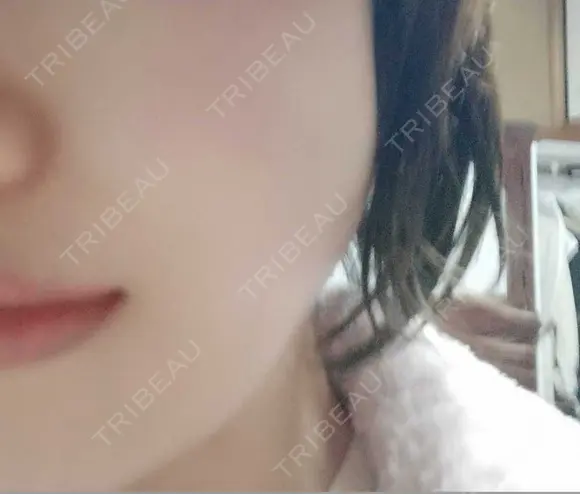 ボトックス（エラ・小顔） 湘南美容クリニック 本厚木院 DAY 59 メイン用