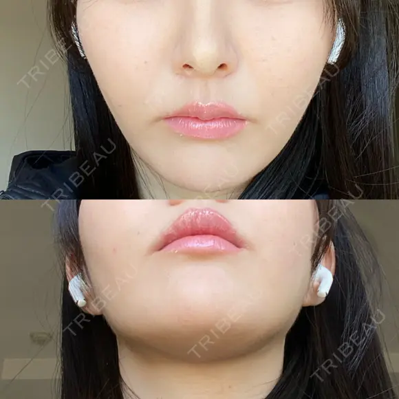 糸リフト / 脂肪吸引（顔） 東京美専クリニック DAY 16 メイン用