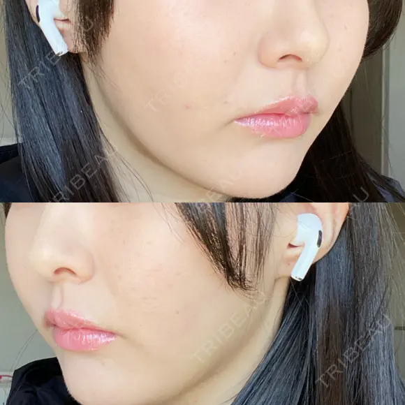 糸リフト / 脂肪吸引（顔） 東京美専クリニック DAY 16 メイン用