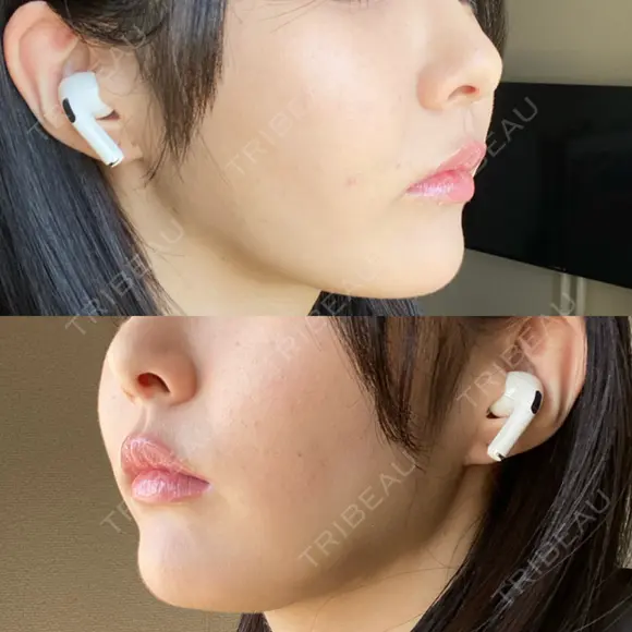 糸リフト / 脂肪吸引（顔） 東京美専クリニック DAY 16 メイン用