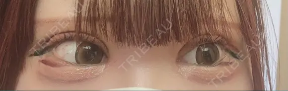 二重切開 / 目頭切開 / 眼瞼下垂（切開） オーキッド美容クリニック東京御徒町 DAY 16 メイン用