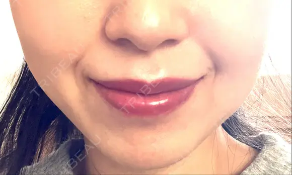 ボトックス（口角） ルラ美容クリニック 名古屋本院 DAY 10 メイン用