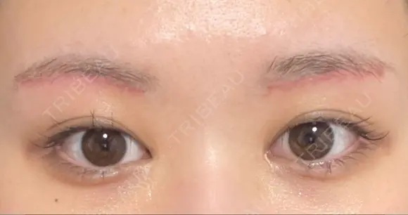 眼瞼下垂（切開） 水の森美容クリニック 福岡院 DAY 30 メイン用