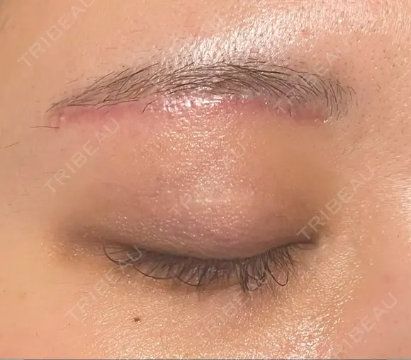 眼瞼下垂（切開） 水の森美容クリニック 福岡院 DAY 30 メイン用