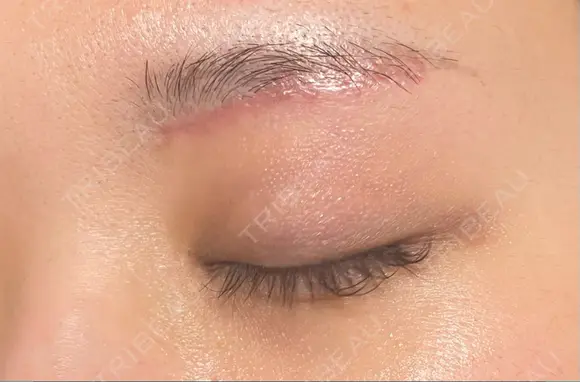 眼瞼下垂（切開） 水の森美容クリニック 福岡院 DAY 30 メイン用