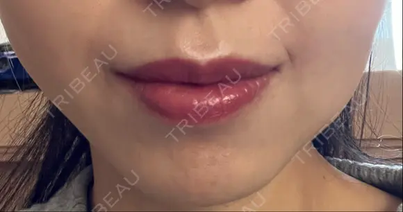 ボトックス（口角） ルラ美容クリニック 名古屋本院 AFTER メイン用