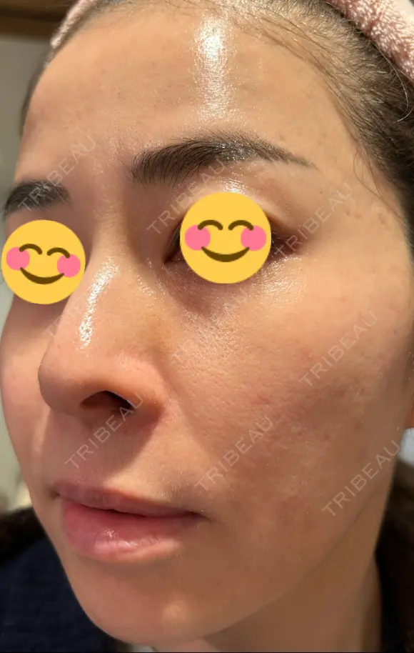 ハイフ（顔） 湘南美容クリニック 高崎院 DAY 10 メイン用
