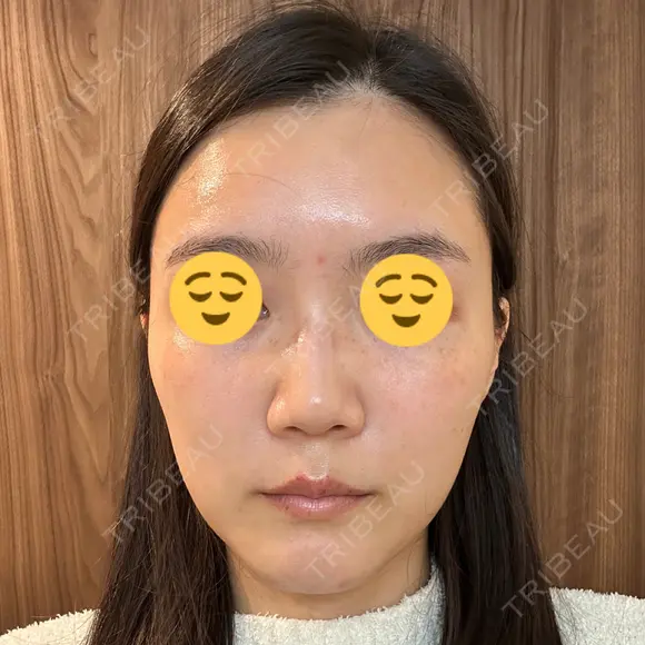 ボトックス（眉間） スキンリファインクリニック銀座 DAY 16 メイン用