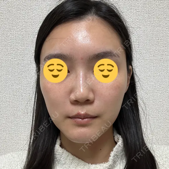 ボトックス（眉間） スキンリファインクリニック銀座 DAY 17 メイン用