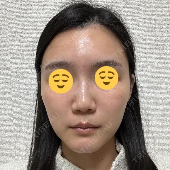 ボトックス（眉間） スキンリファインクリニック銀座 DAY 17 メイン用