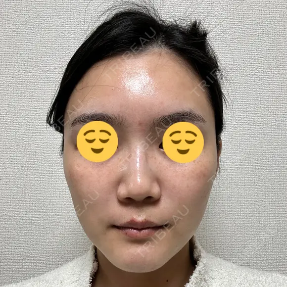 ボトックス（眉間） スキンリファインクリニック銀座 DAY 18 メイン用