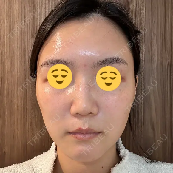 ボトックス（眉間） スキンリファインクリニック銀座 DAY 19 メイン用