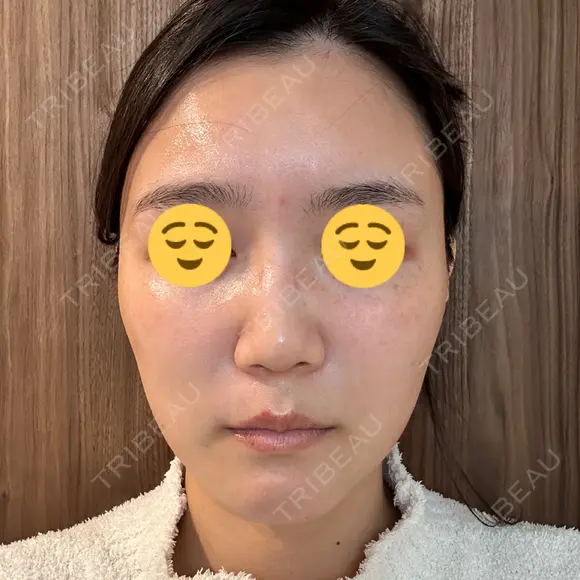 ボトックス（眉間） スキンリファインクリニック銀座 DAY 19 メイン用