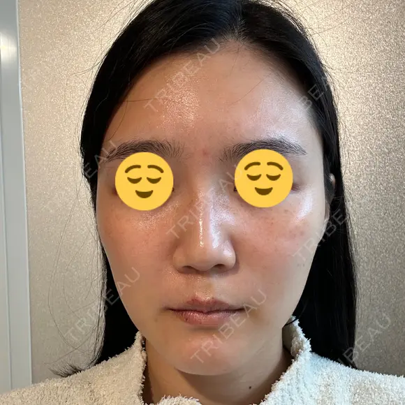 ボトックス（眉間） スキンリファインクリニック銀座 AFTER メイン用