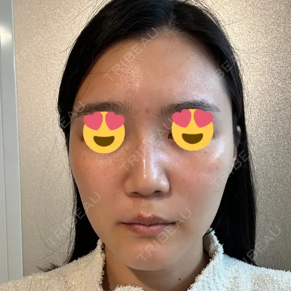 ボトックス（眉間） スキンリファインクリニック銀座 DAY 21 メイン用