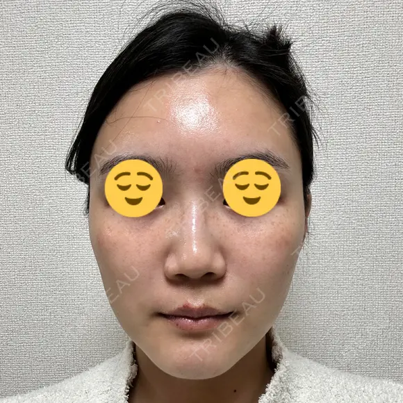 ボトックス（エラ・小顔） スキンリファインクリニック銀座 DAY 18 メイン用