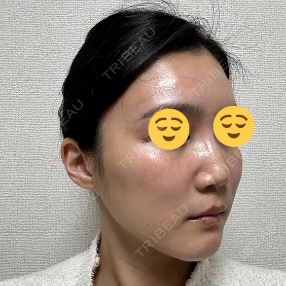 ボトックス（エラ・小顔） スキンリファインクリニック銀座 DAY 18 メイン用