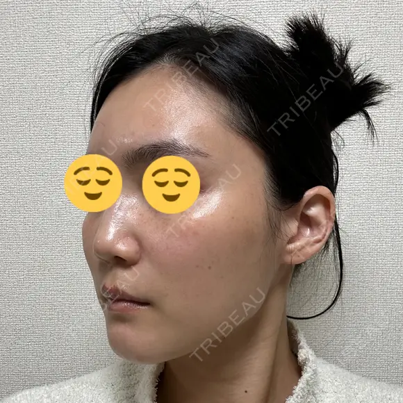 ボトックス（エラ・小顔） スキンリファインクリニック銀座 DAY 18 メイン用