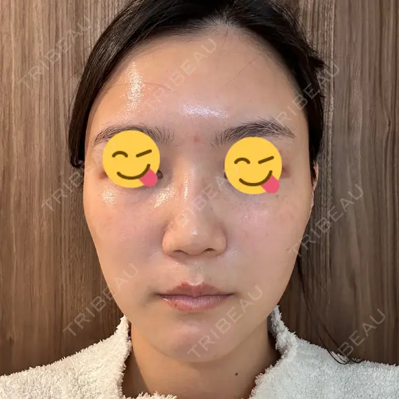 ボトックス（エラ・小顔） スキンリファインクリニック銀座 DAY 19 メイン用