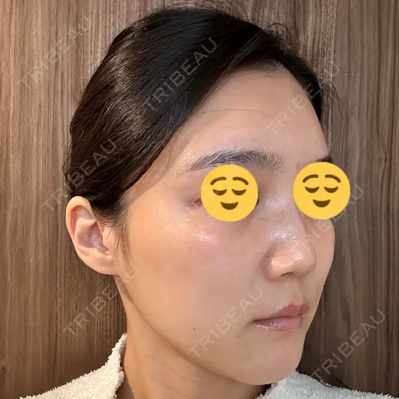 ボトックス（エラ・小顔） スキンリファインクリニック銀座 DAY 19 メイン用