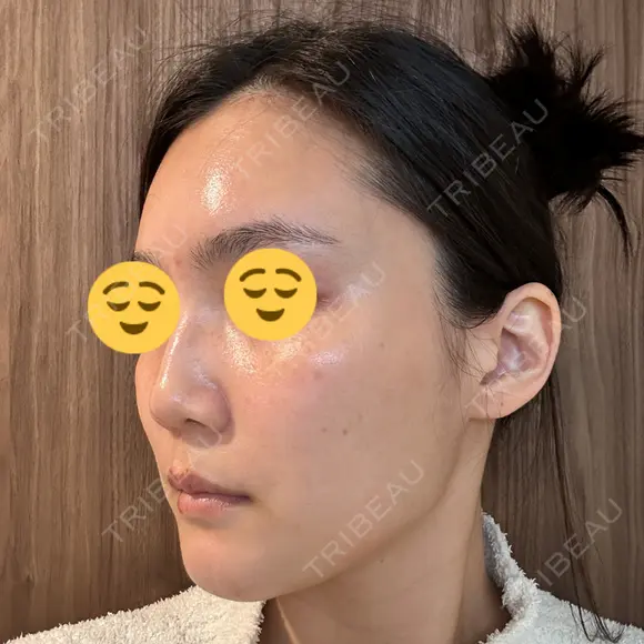 ボトックス（エラ・小顔） スキンリファインクリニック銀座 DAY 19 メイン用