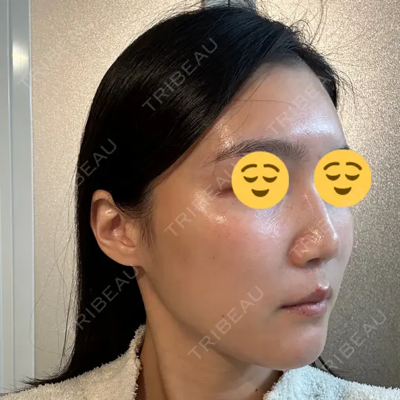 ボトックス（エラ・小顔） スキンリファインクリニック銀座 DAY 20 メイン用