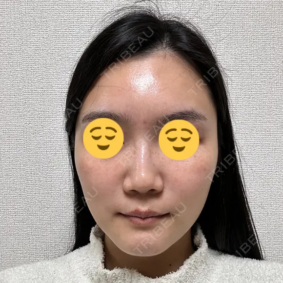 エレクトロポレーション 湘南美容クリニック Regno 銀座院 DAY 2 メイン用