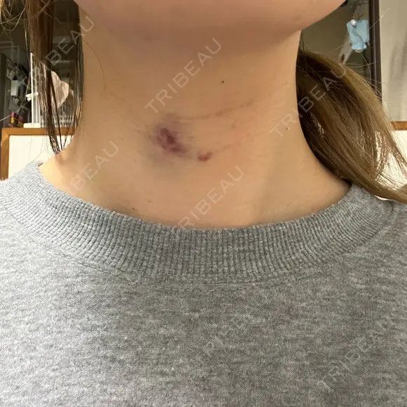 肌ヒアルロン酸注入（たるみ・シワ改善） ルラ美容クリニック 名古屋本院 DAY 1 メイン用