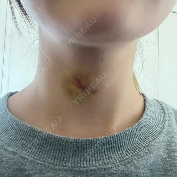 肌ヒアルロン酸注入（たるみ・シワ改善） ルラ美容クリニック 名古屋本院 DAY 4 メイン用