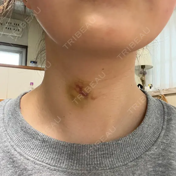 肌ヒアルロン酸注入（たるみ・シワ改善） ルラ美容クリニック 名古屋本院 DAY 5 メイン用