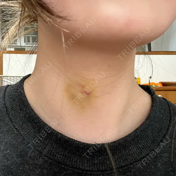 肌ヒアルロン酸注入（たるみ・シワ改善） ルラ美容クリニック 名古屋本院 DAY 7 メイン用