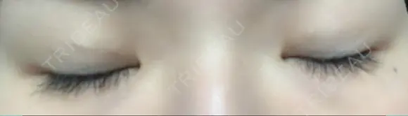 二重埋没 湘南美容クリニック 大阪心斎橋院 DAY 16 メイン用