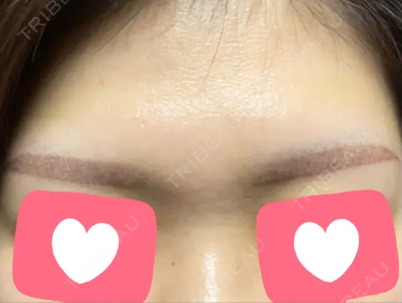アートメイク（眉） LEAGRANT CLINIC 中目黒 DAY 1 メイン用