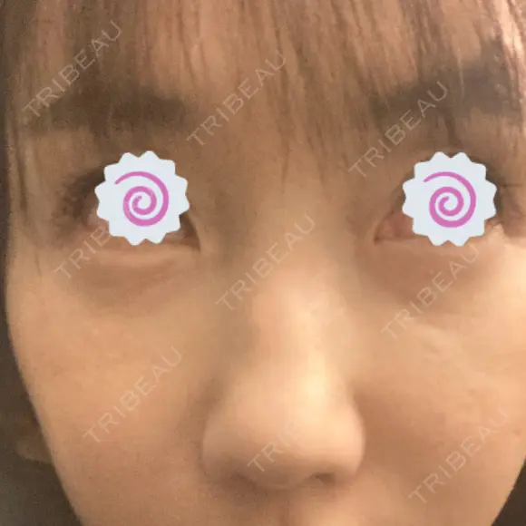 ベビーコラーゲン / サーマクール 新宿ラクル美容外科クリニック 新宿院 AFTER メイン用