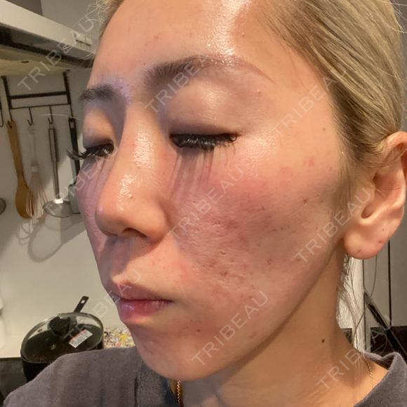 ポテンツァ NARU Beauty Clinic 【ナルクリ】 AFTER メイン用