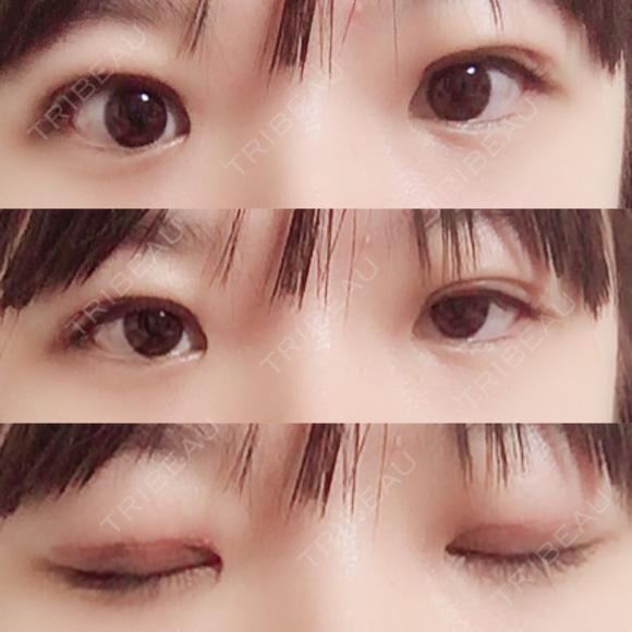 二重切開 / 上まぶたの脂肪取り 聖心美容クリニック 横浜院 DAY 18 メイン用