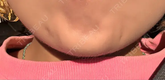ボトックス（あご） KAGA CLINIC AFTER メイン用