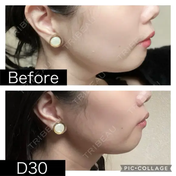 脂肪溶解注射（顔） SK新宿歌舞伎町美容外科・歯科 DAY 30 メイン用