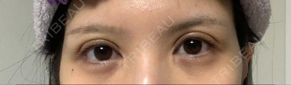 二重切開 / 目頭切開 / 眼瞼下垂（切開） / 上まぶたの脂肪取り エターナル美容クリニック DAY 64 メイン用