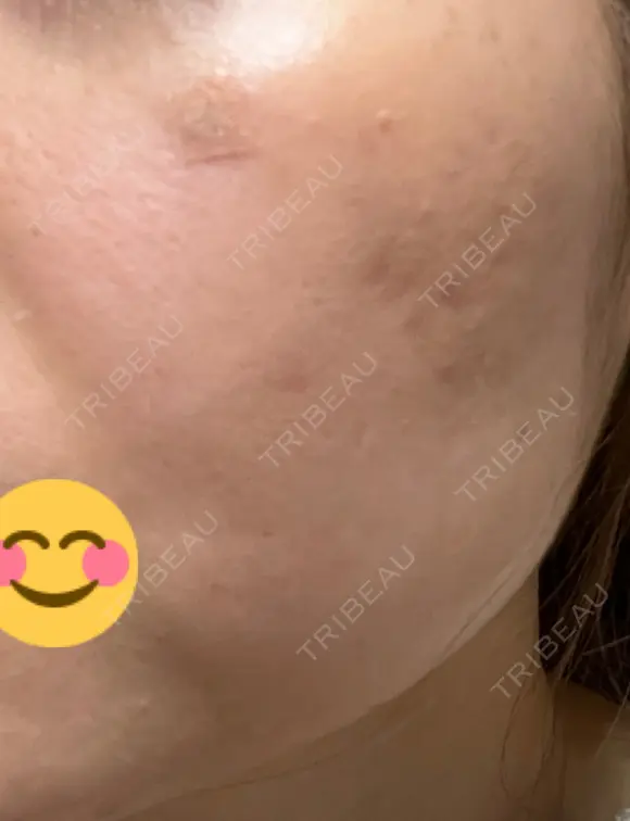 ほくろ・いぼ除去レーザー（肌） / シミ取りレーザー / ピコスポット 日比谷セントラルクリニック DAY 4 メイン用