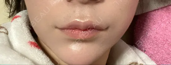 ボトックス（人中） Taide Suenaga Clinic（タイデスエナガクリニック） AFTER メイン用