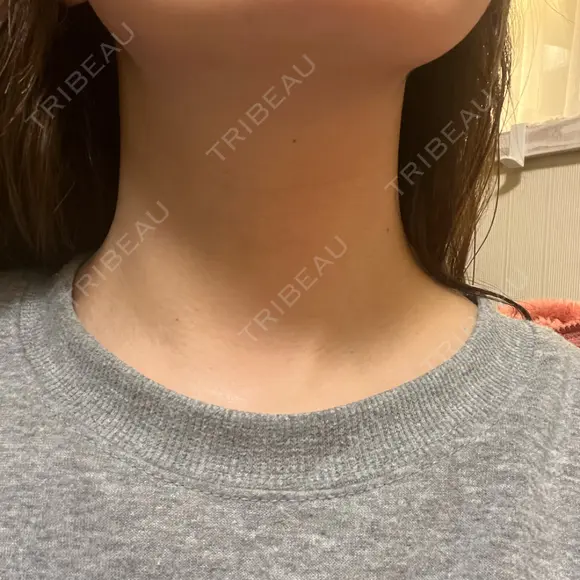 肌ヒアルロン酸注入（たるみ・シワ改善） ルラ美容クリニック 名古屋本院 AFTER メイン用