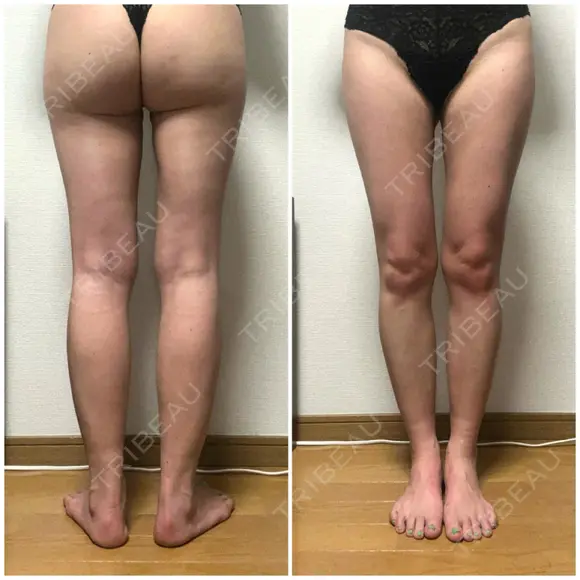 脂肪吸引（脚） / 豊胸（脂肪注入） GAYA body design clinic DAY 61 メイン用